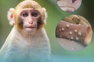 Việt Nam đã triển khai nhiều giải pháp ứng phó với dịch bệnh đậu mùa khỉ