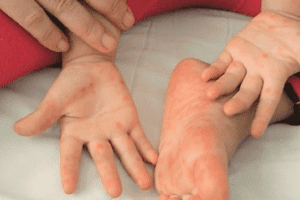MỐI NGUY KHI MẮC BỆNH TAY CHÂN MIỆNG