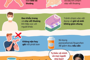 CHỦ ĐỘNG THỰC HIỆN CÁC BIỆN PHÁP PHÒNG BỆNH ĐẬU MÙA KHỈ