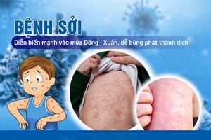 THỦ TƯỚNG YÊU CẦU TĂNG CƯỜNG CÁC BIỆN PHÁP PHÒNG, CHỐNG BỆNH SỞI