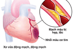 BỆNH TIM MẠCH - KẺ GIẾT NGƯỜI THẦM LẶNG