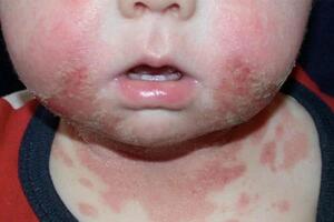 NHỮNG ĐIỀU CẦN BIẾT VỀ VIÊM DA CƠ ĐỊA