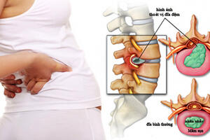 4 GIAI ĐOẠN BỆNH THOÁT VỊ ĐĨA ĐỆM VÀ NHỮNG ĐIỀU CẦN LƯU Ý