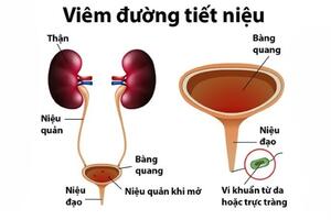 VIÊM ĐƯỜNG TIẾT NIỆU - NHẬN BIẾT SỚM ĐỂ ĐIỀU TRỊ KỊP THỜI