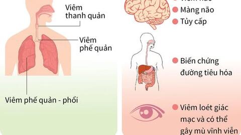 Bệnh sởi nguy hiểm như thế nào?