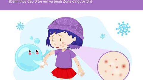BỆNH THỦY ĐẬU NHỮNG ĐIỀU CẦN BIẾT