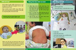 CẢNH GIÁC VỚI BIẾN CHỨNG NGUY HIỂM CỦA BỆNH SỞI Ở TRẺ EM