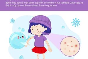 BỆNH THỦY ĐẬU NHỮNG ĐIỀU CẦN BIẾT