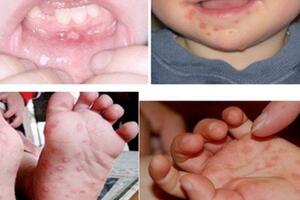 Chủ động phòng, chống bệnh tay chân miệng