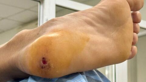 UỐN VÁN - CĂN BỆNH CÓ THỂ GÂY TỬ VONG CHỈ TỪ  MỘT VẾT THƯƠNG NHỎ