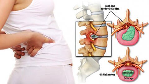 4 GIAI ĐOẠN BỆNH THOÁT VỊ ĐĨA ĐỆM VÀ NHỮNG ĐIỀU CẦN LƯU Ý