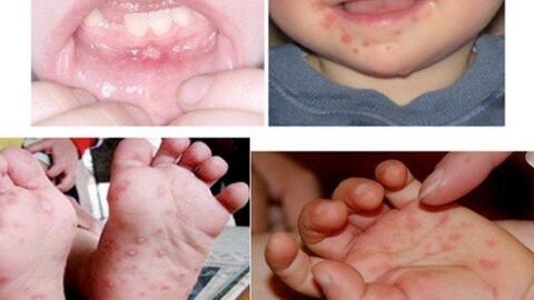 Chủ động phòng, chống bệnh tay chân miệng