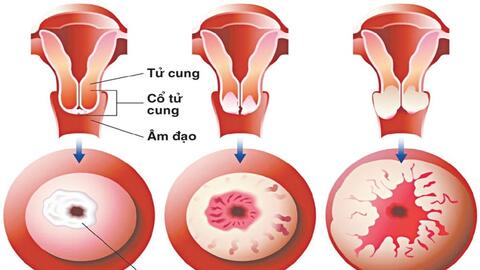 Những dấu hiệu cảnh báo ung thư cổ tử cung ở phụ nữ trẻ