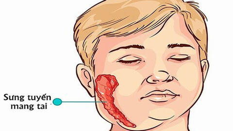 Tăng cường phòng, chống bệnh quai bị trong trường học tại Lâm Đồng